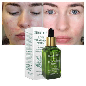عرض رمضاني 🕌خاص بخصم❤️% 30-BREYLEE Acne Treatment Serum – Scar Removal & Pimple Repair Cream