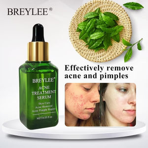 عرض رمضاني 🕌خاص بخصم❤️% 30-BREYLEE Acne Treatment Serum – Scar Removal & Pimple Repair Cream