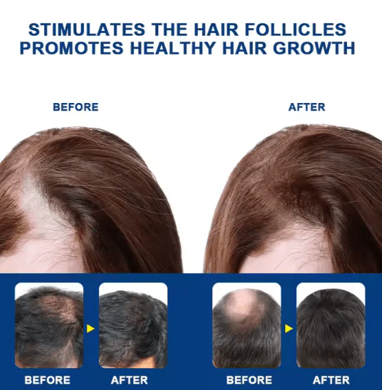 Sumifun  Hair Growth Cream (Original) Natural Treatment for Hair Loss & Regrowth